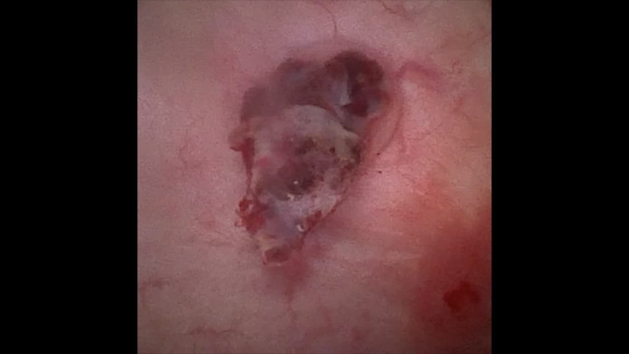 膀胱鏡(軟性内視鏡)で観察した犬の膀胱内の腫瘤。粘膜から盛り上がった病変が確認できる