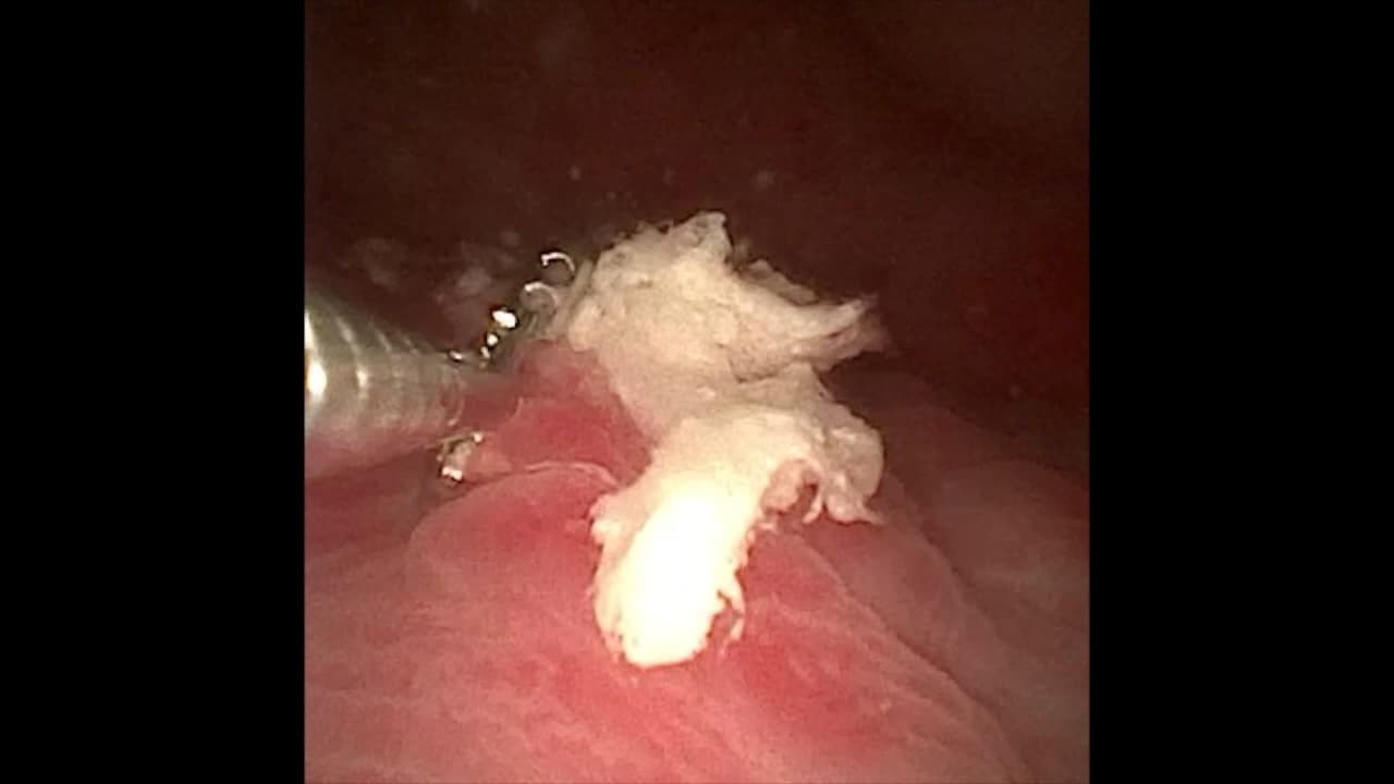 膀胱鏡下で、膀胱内の腫瘤に生検鉗子を近づけて組織を採取しようとしている場面