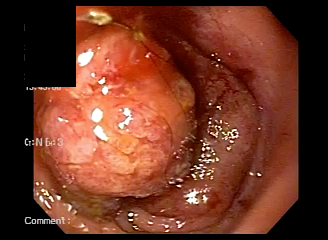 大腸内視鏡で見たポリープ。粘膜から盛り上がった隆起として見える