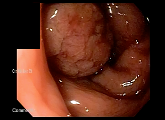 大腸内視鏡で見た別のポリープ。見た目だけでは炎症か腫瘍かを判断できない