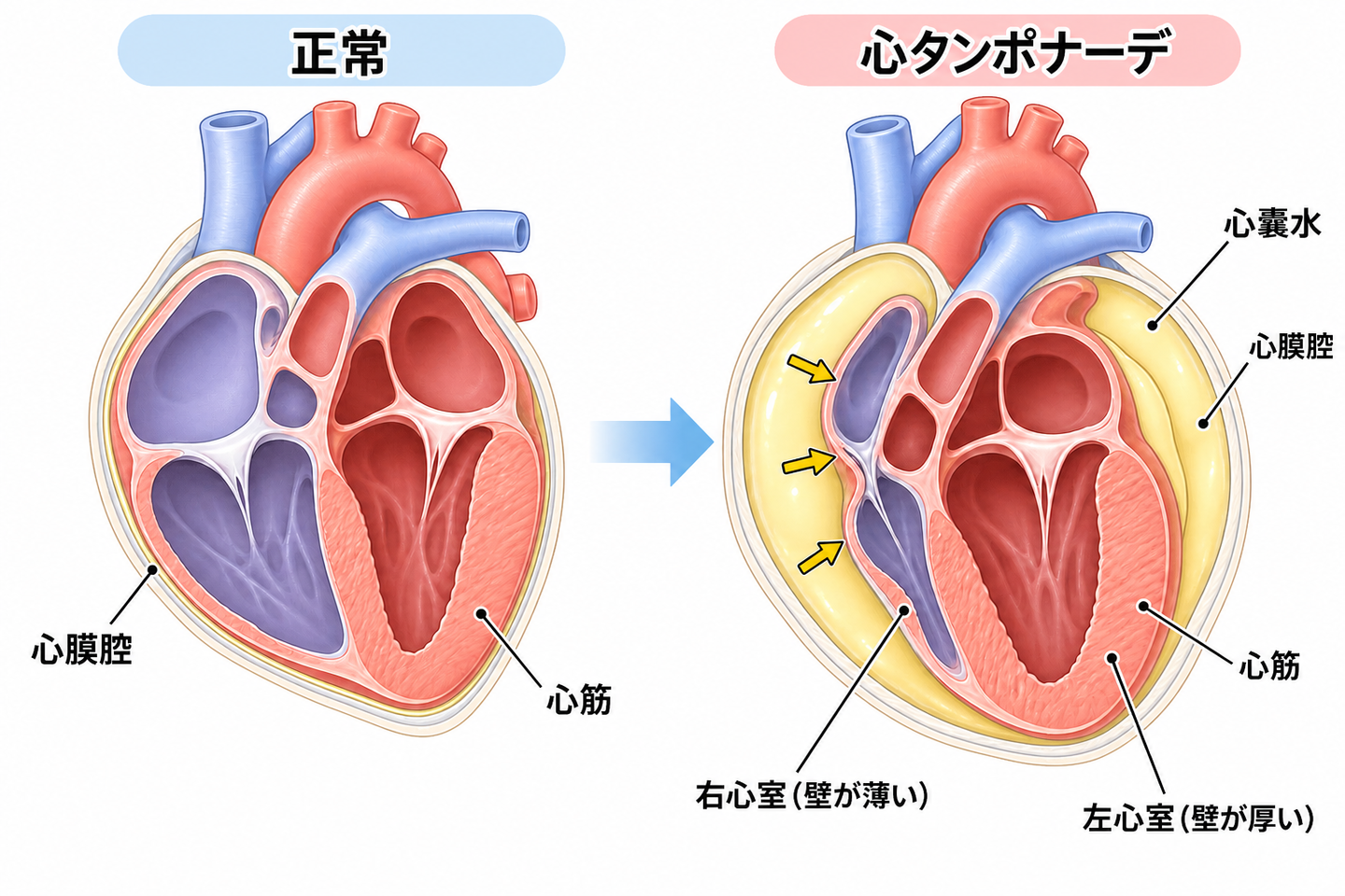心嚢水が心膜腔にたまり心臓が圧迫される様子を示す断面図