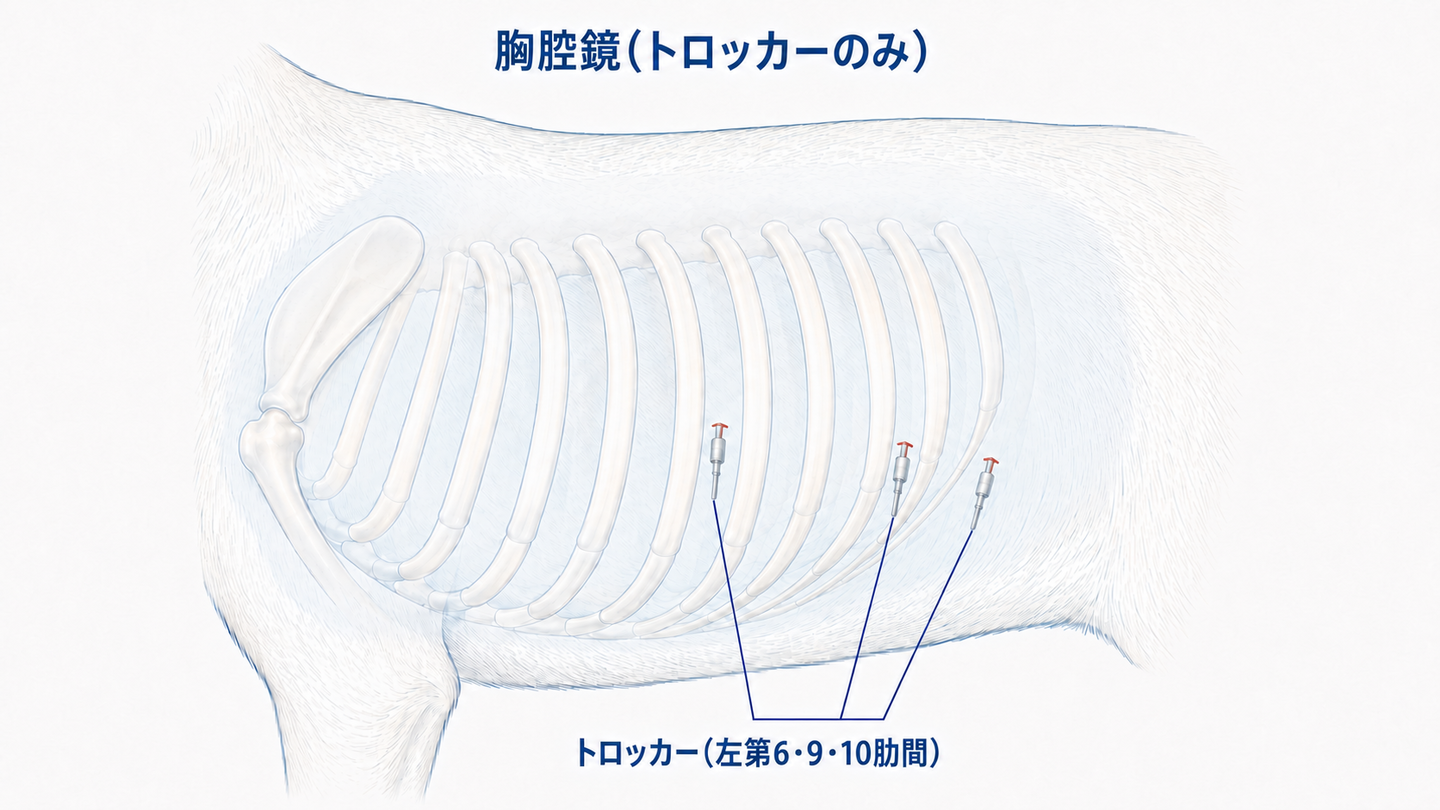 胸腔鏡下心膜切除術のトロッカー位置(左第6・9・10肋間)