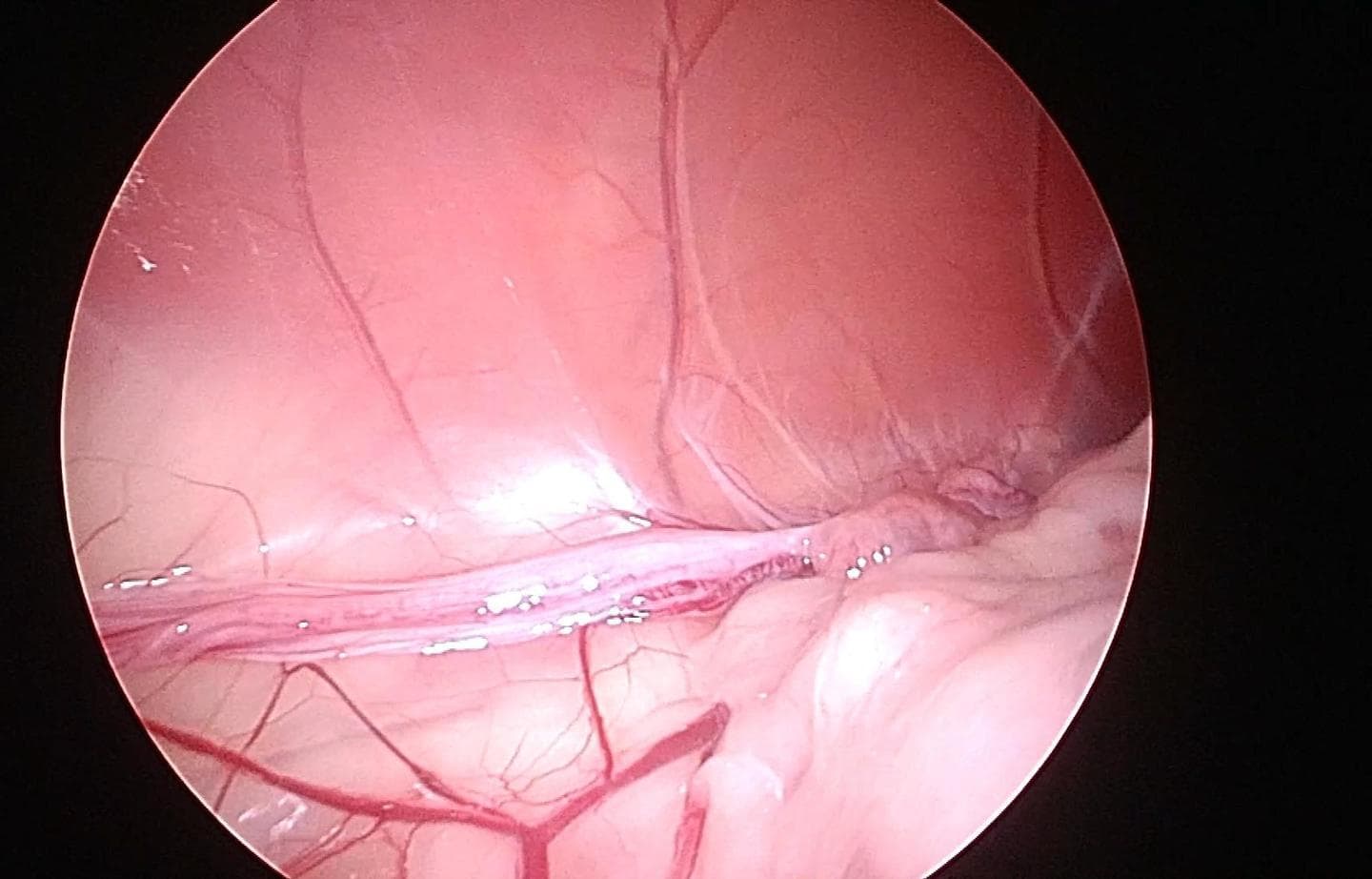 片側の子宮角が細くなっている状態の腹腔鏡画像(今回の症例)
