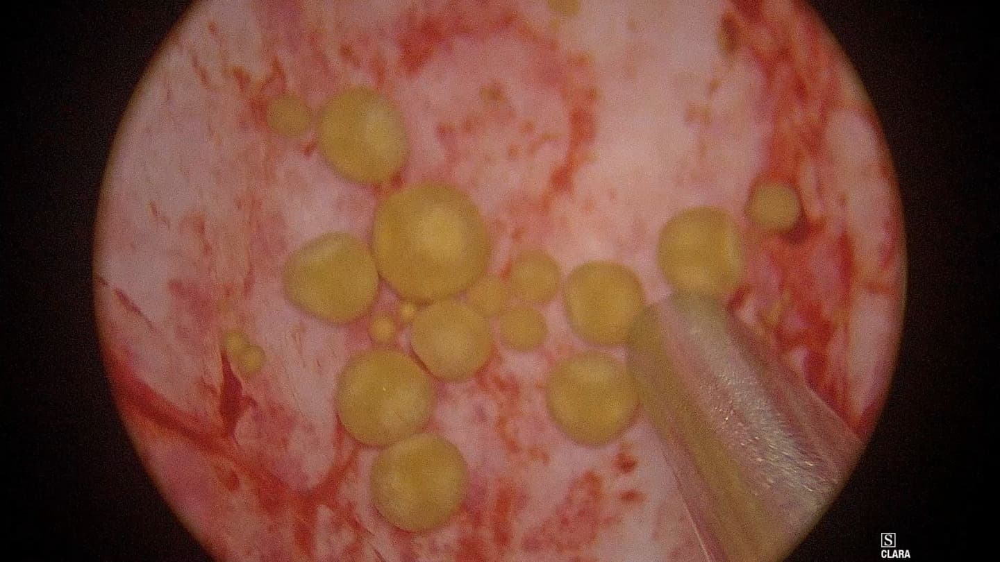 吸引管で結石を吸引しようとしている膀胱鏡下の画像
