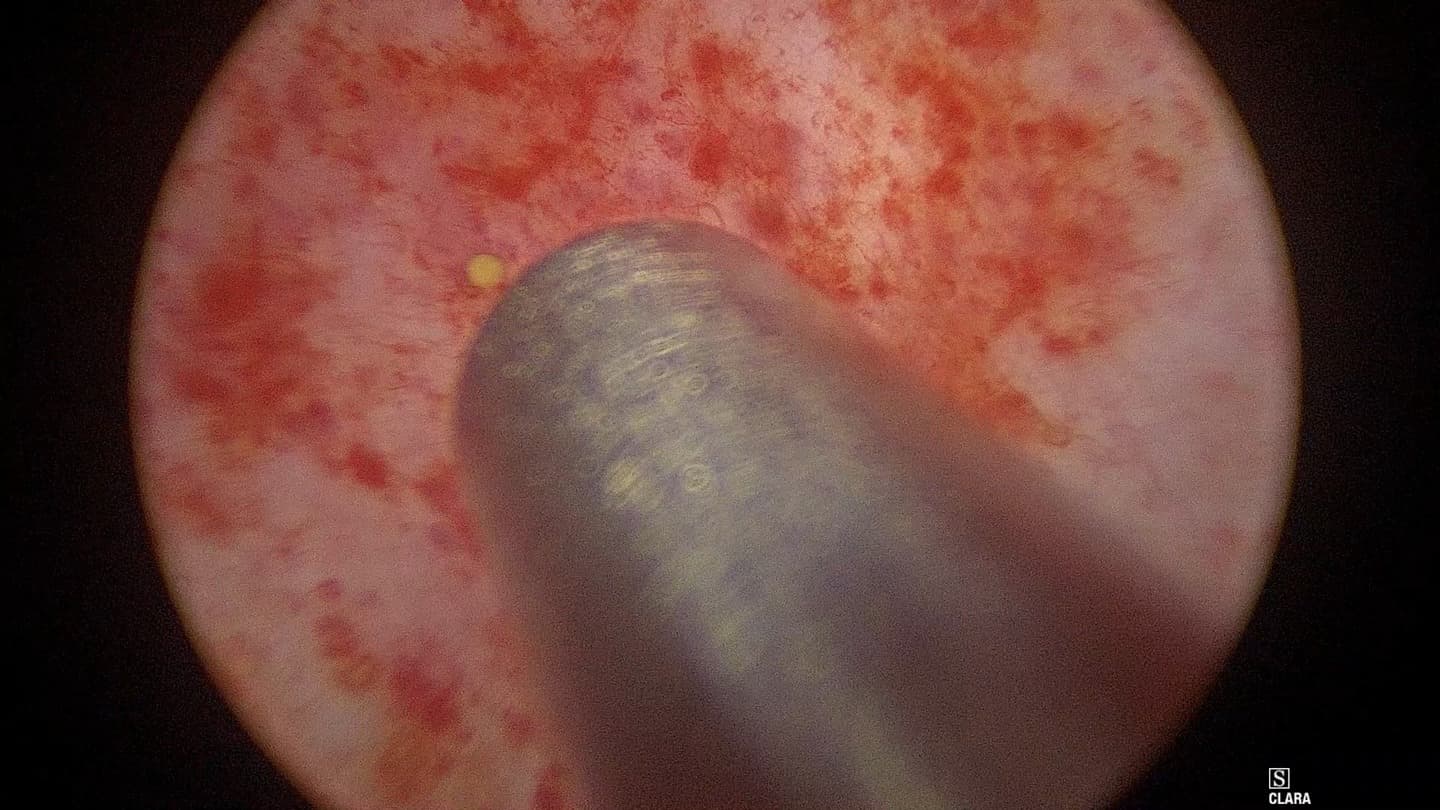 吸引管の先端が微細な結石をとらえている膀胱鏡下の画像
